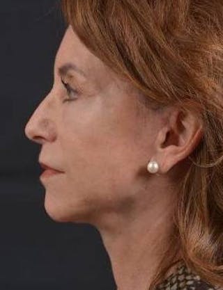 Facelift Before & After Gallery - Patient 353511 - Image 4