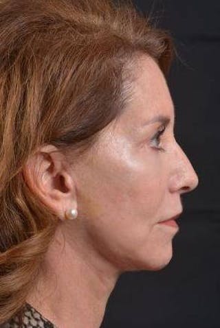 Facelift Before & After Gallery - Patient 353511 - Image 6