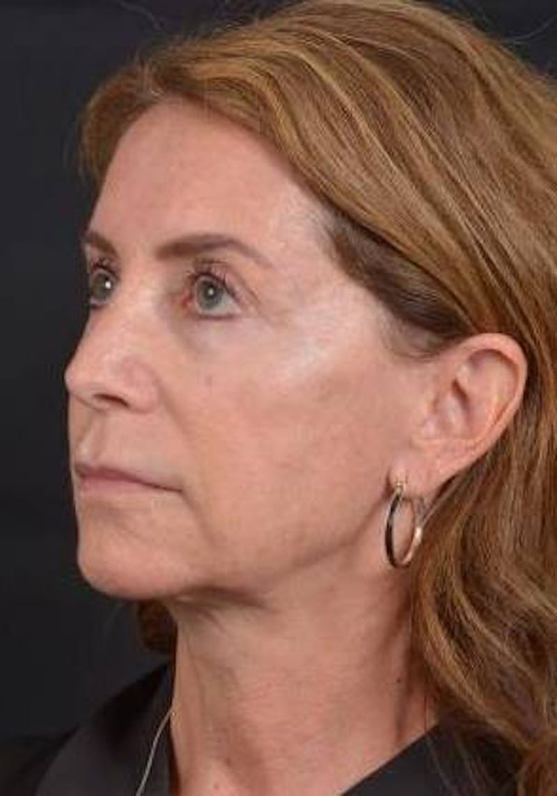 Facelift Before & After Gallery - Patient 353511 - Image 7