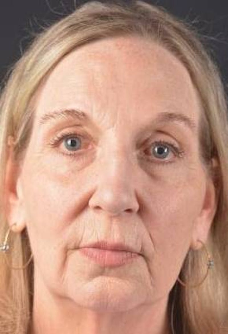 Facelift Before & After Gallery - Patient 338671 - Image 1