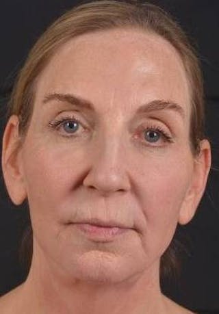 Facelift Before & After Gallery - Patient 338671 - Image 2