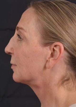 Facelift Before & After Gallery - Patient 338671 - Image 4