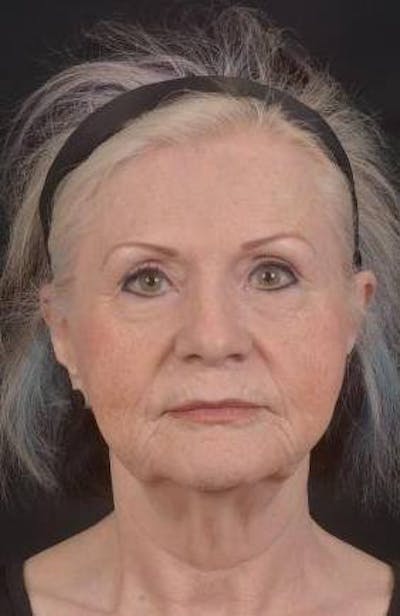 Facelift Before & After Gallery - Patient 385952 - Image 1
