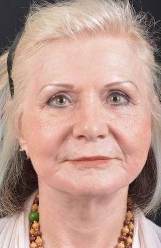 Facelift Before & After Gallery - Patient 385952 - Image 2