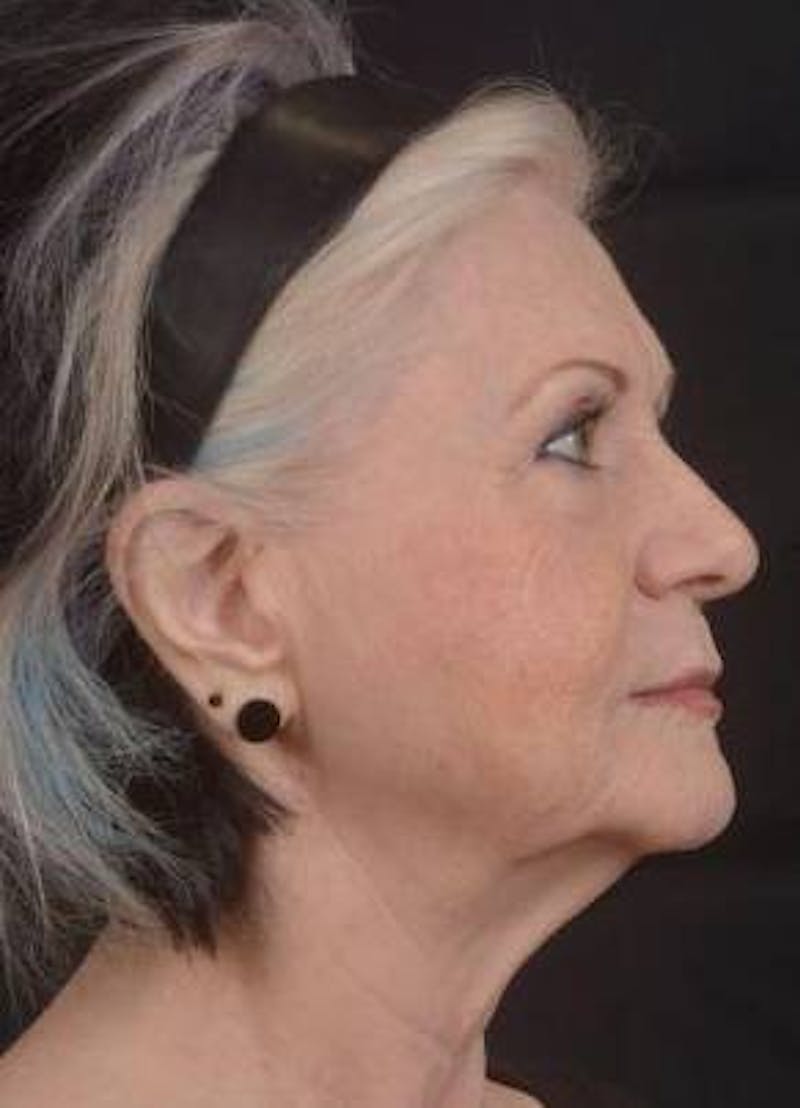 Facelift Before & After Gallery - Patient 385952 - Image 5