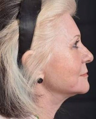 Facelift Before & After Gallery - Patient 385952 - Image 6