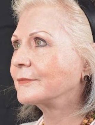 Facelift Before & After Gallery - Patient 385952 - Image 8