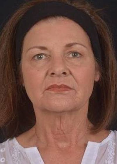 Facelift Before & After Gallery - Patient 190358 - Image 1