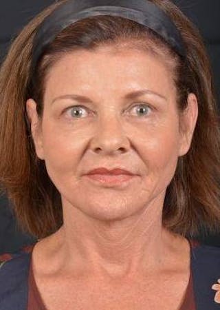 Facelift Before & After Gallery - Patient 190358 - Image 2