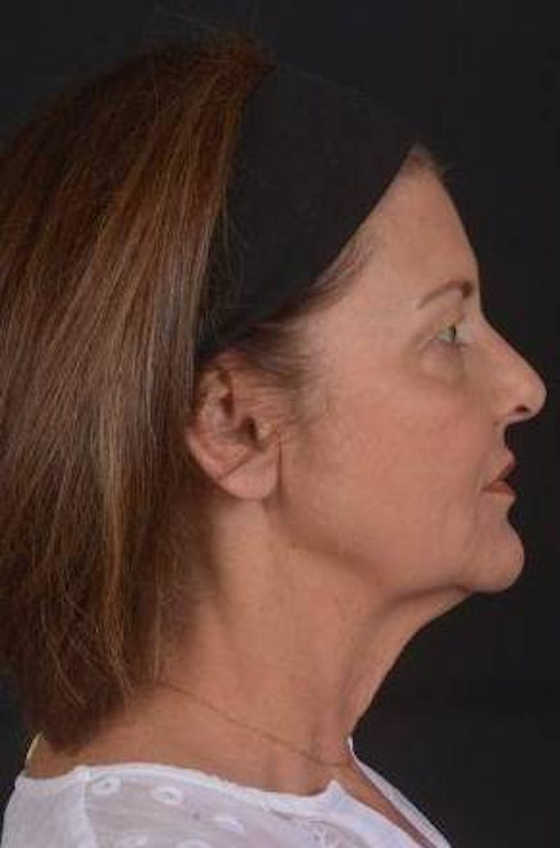 Facelift Before & After Gallery - Patient 190358 - Image 5