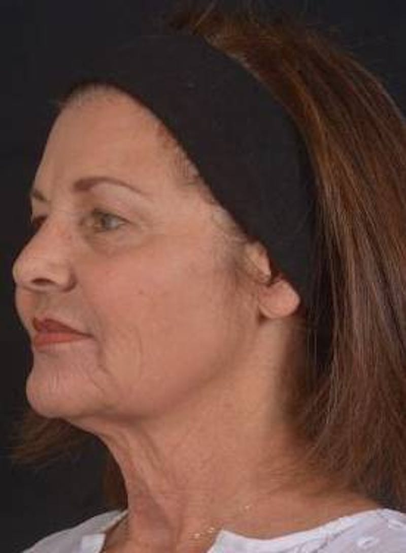 Facelift Before & After Gallery - Patient 190358 - Image 7