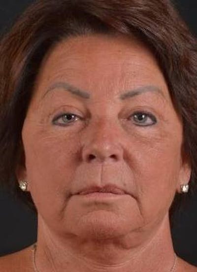 Facelift Before & After Gallery - Patient 107378 - Image 1