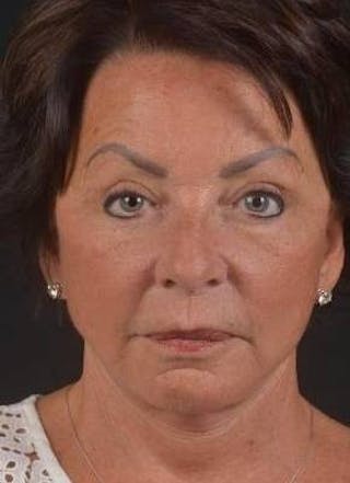 Facelift Before & After Gallery - Patient 107378 - Image 2