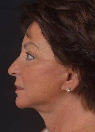 Facelift Before & After Gallery - Patient 107378 - Image 4