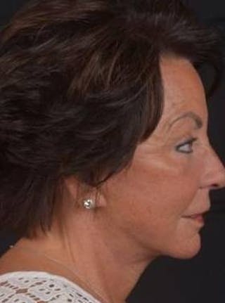 Facelift Before & After Gallery - Patient 107378 - Image 6