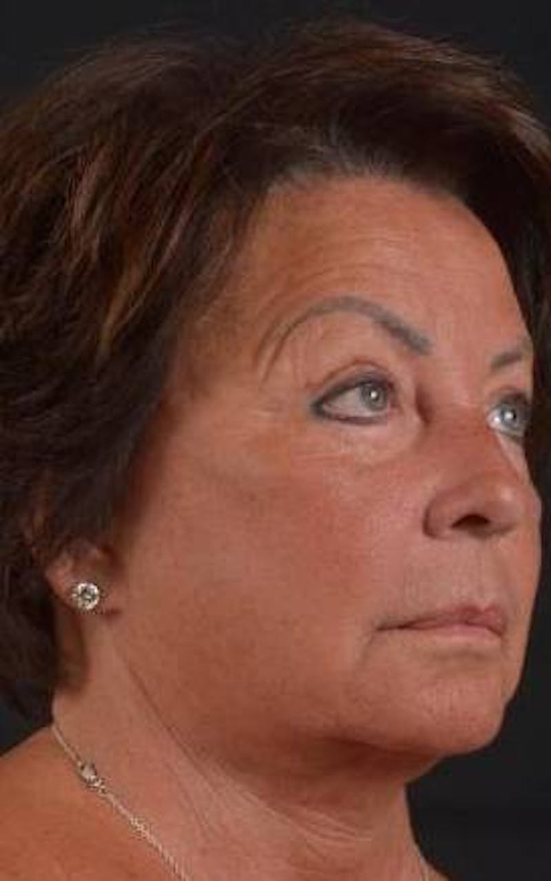 Facelift Before & After Gallery - Patient 107378 - Image 7