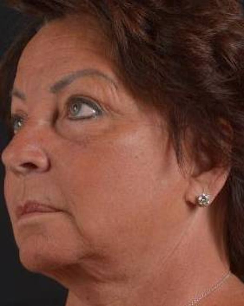 Facelift Before & After Gallery - Patient 107378 - Image 9
