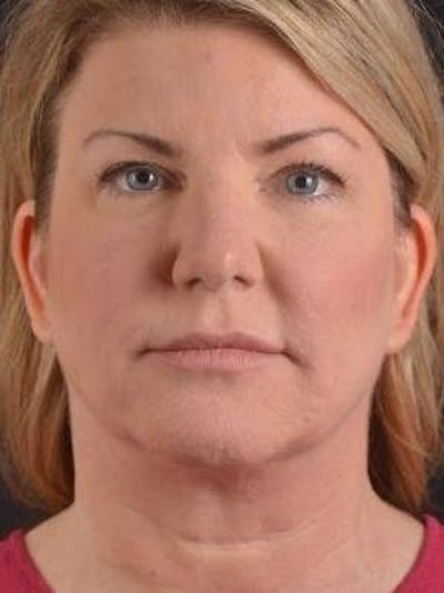 Facelift Before & After Gallery - Patient 481884 - Image 1