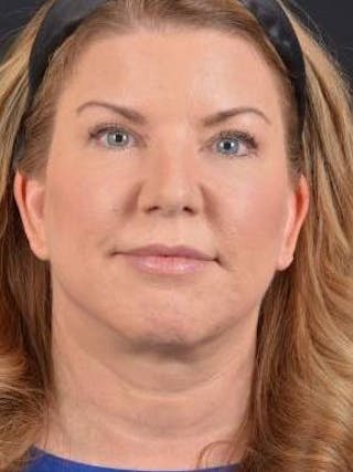 Facelift Before & After Gallery - Patient 481884 - Image 2