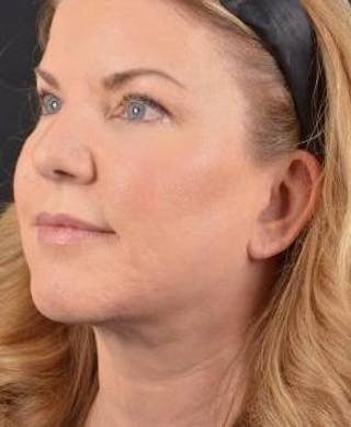 Facelift Before & After Gallery - Patient 481884 - Image 8