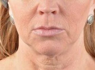 Facelift Before & After Gallery - Patient 129408 - Image 1