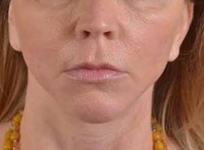 Facelift Before & After Gallery - Patient 129408 - Image 2