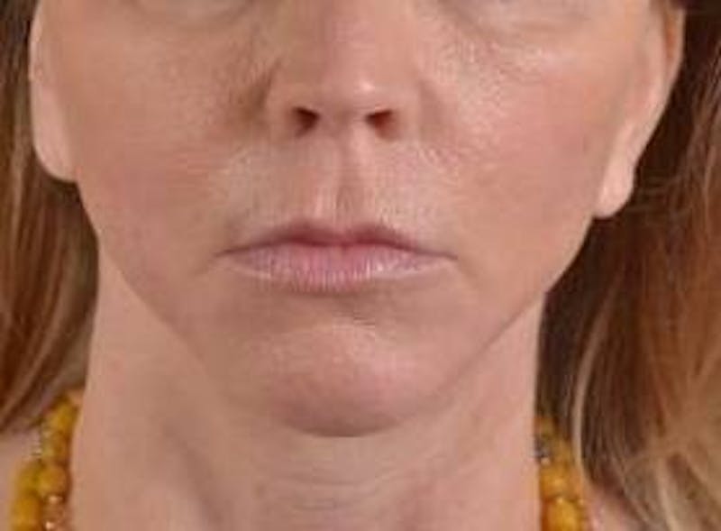 Facelift Before & After Gallery - Patient 129408 - Image 2