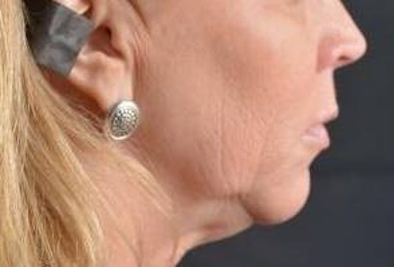 Facelift Before & After Gallery - Patient 129408 - Image 5