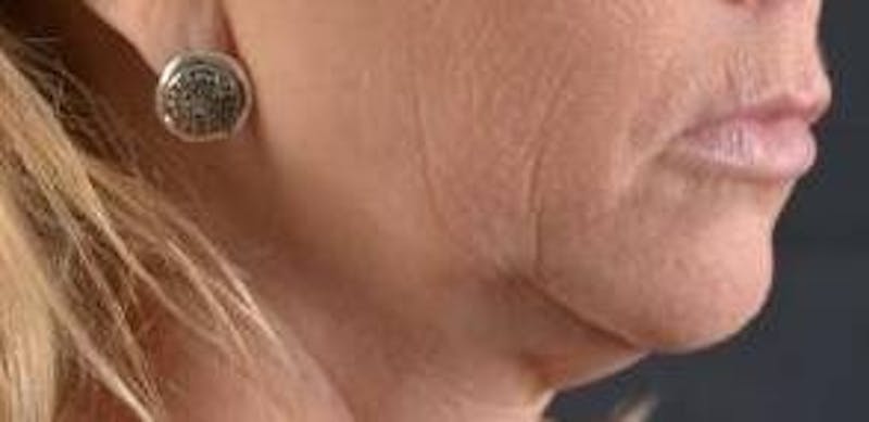 Facelift Before & After Gallery - Patient 129408 - Image 9