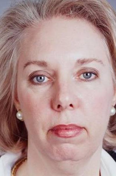 Facelift Before & After Gallery - Patient 338810 - Image 1