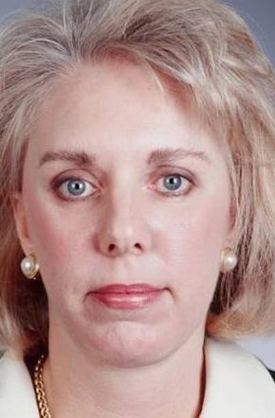Facelift Before & After Gallery - Patient 338810 - Image 2