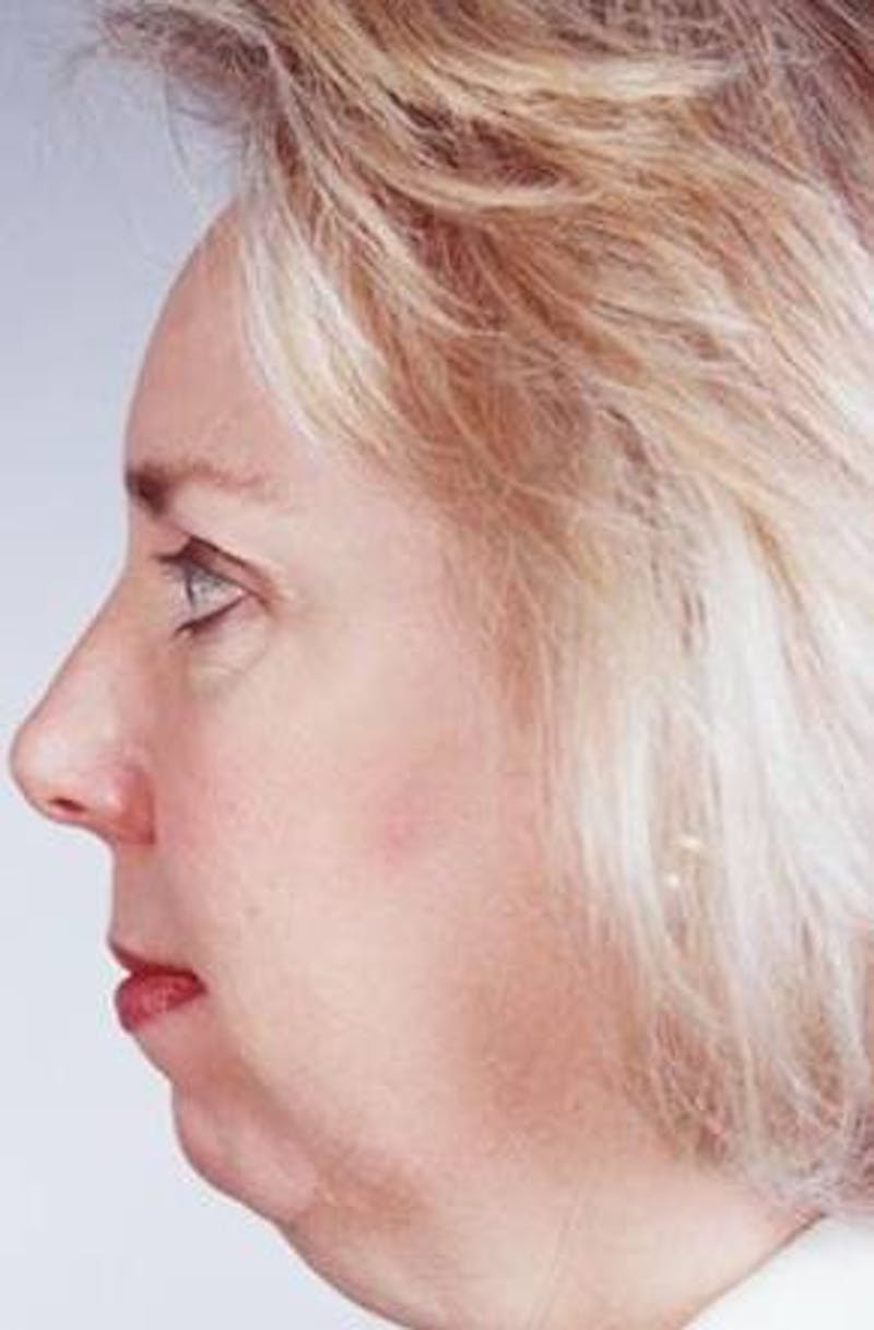 Facelift Before & After Gallery - Patient 338810 - Image 3