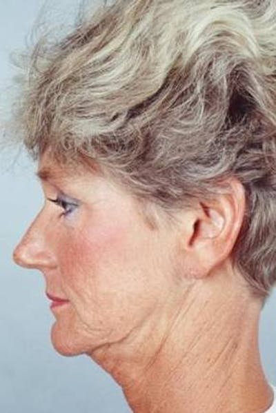 Facelift Before & After Gallery - Patient 173246 - Image 1