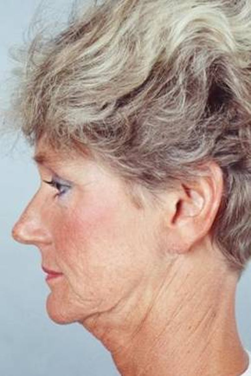 Facelift Before & After Gallery - Patient 173246 - Image 1