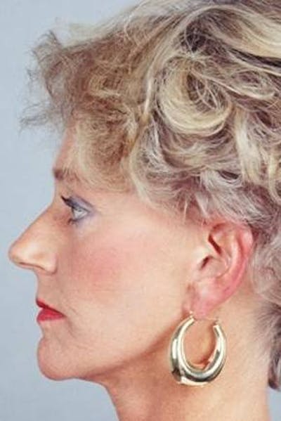 Facelift Before & After Gallery - Patient 173246 - Image 2