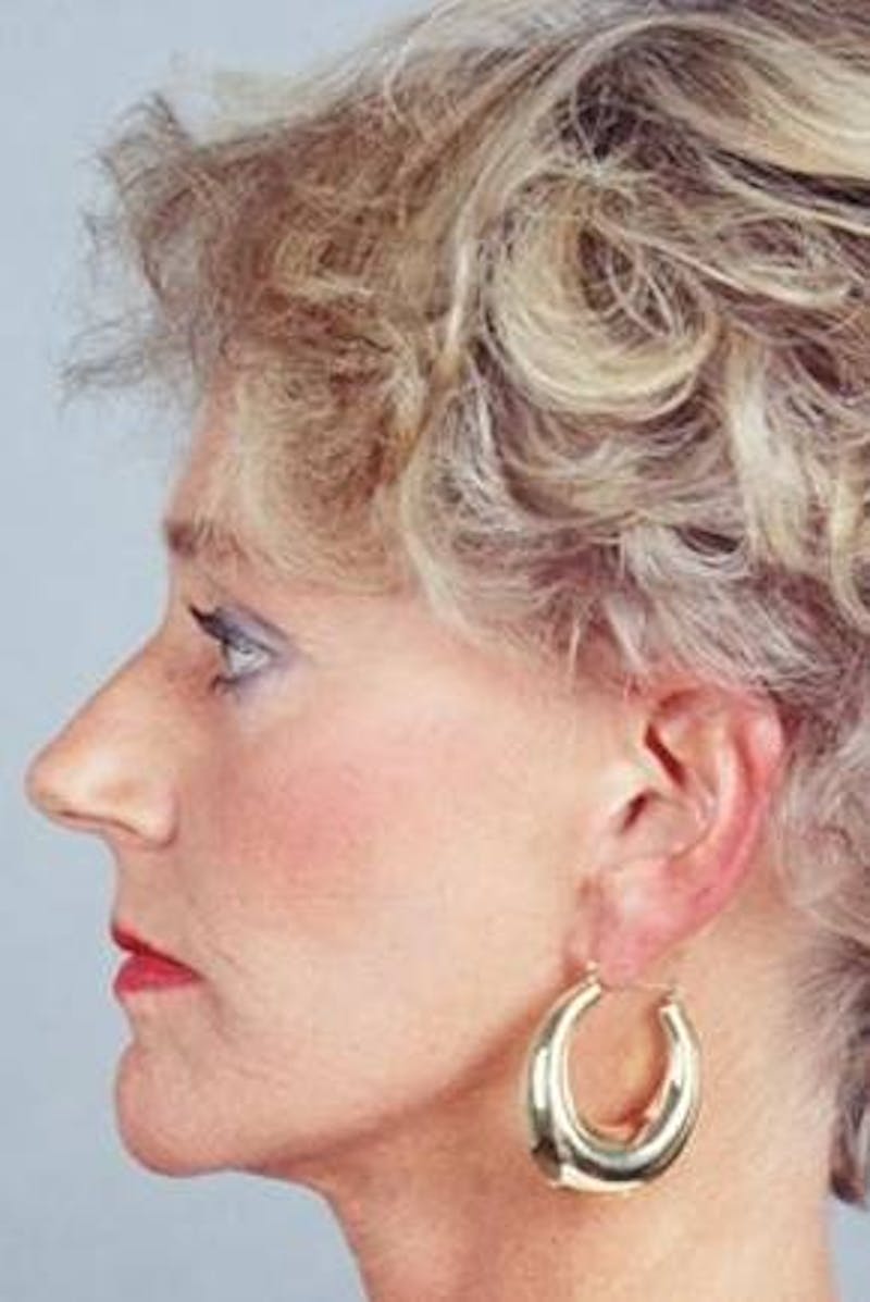 Facelift Before & After Gallery - Patient 173246 - Image 2