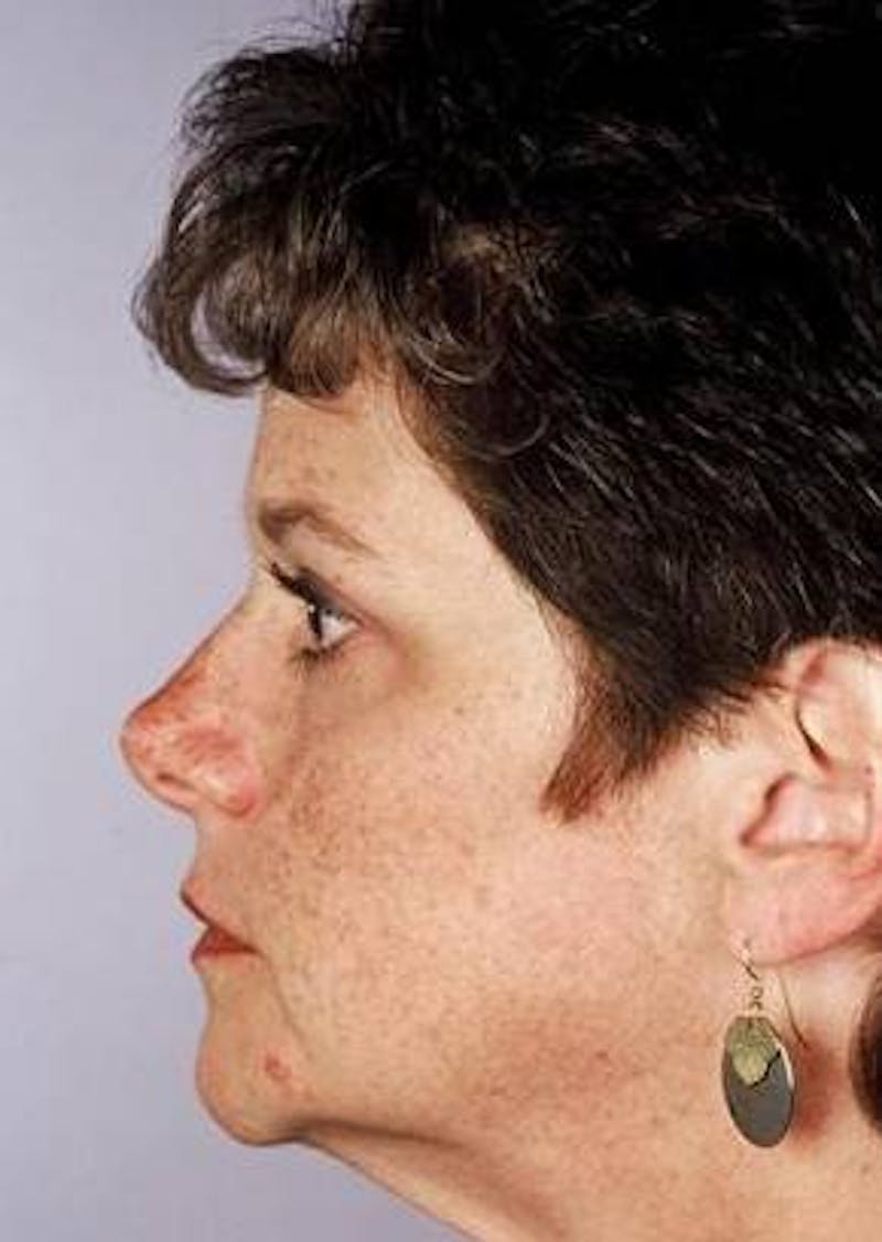 Facelift Before & After Gallery - Patient 375328 - Image 1