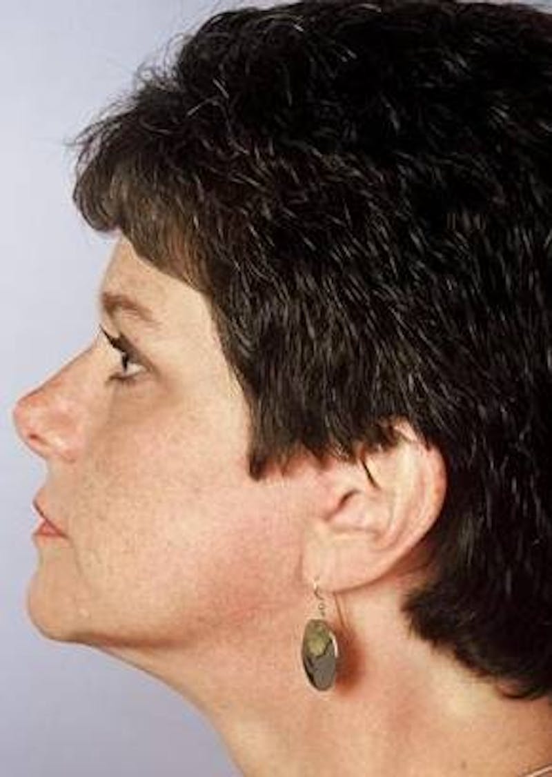 Facelift Before & After Gallery - Patient 375328 - Image 2