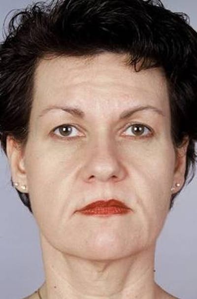 Facelift Before & After Gallery - Patient 260828 - Image 1
