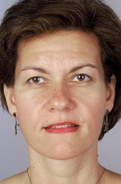 Facelift Before & After Gallery - Patient 260828 - Image 2