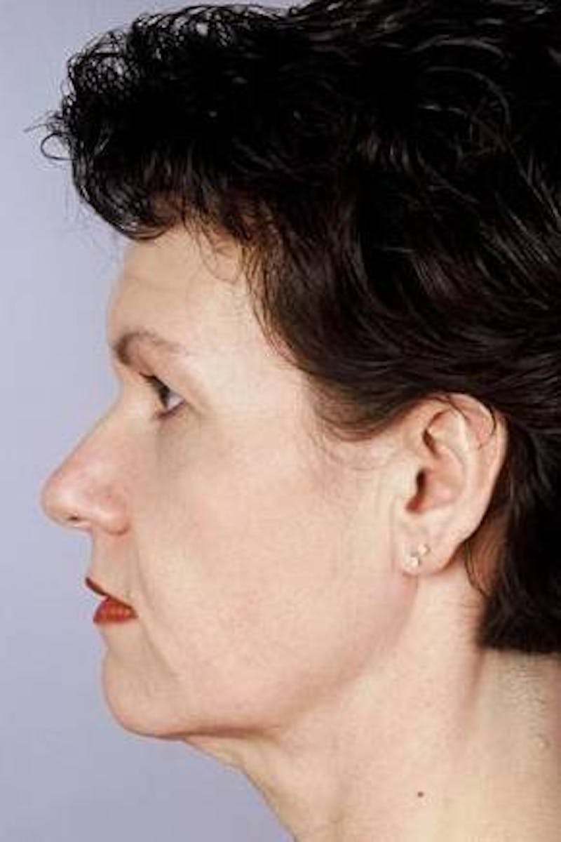 Facelift Before & After Gallery - Patient 260828 - Image 3