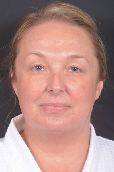 Facelift Before & After Gallery - Patient 125952 - Image 1