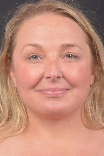 Facelift Before & After Gallery - Patient 125952 - Image 2