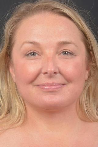 Facelift Before & After Gallery - Patient 125952 - Image 2