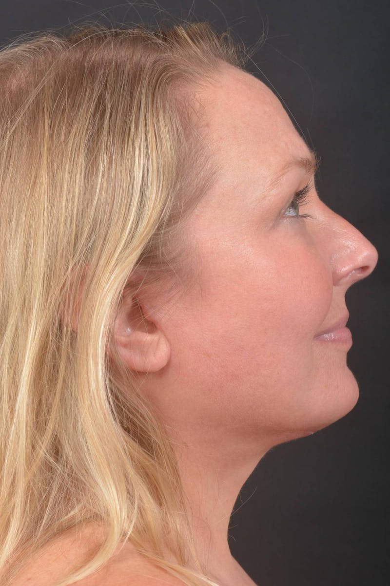 Facelift Before & After Gallery - Patient 125952 - Image 4