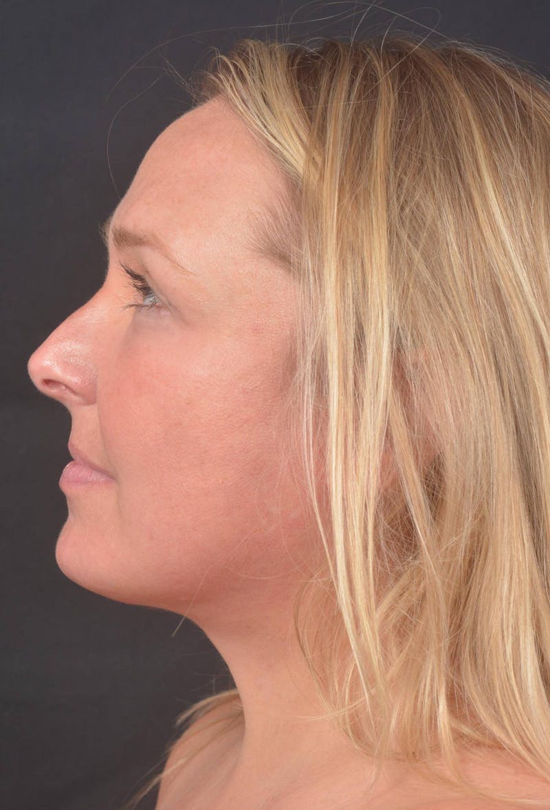 Facelift Before & After Gallery - Patient 125952 - Image 6