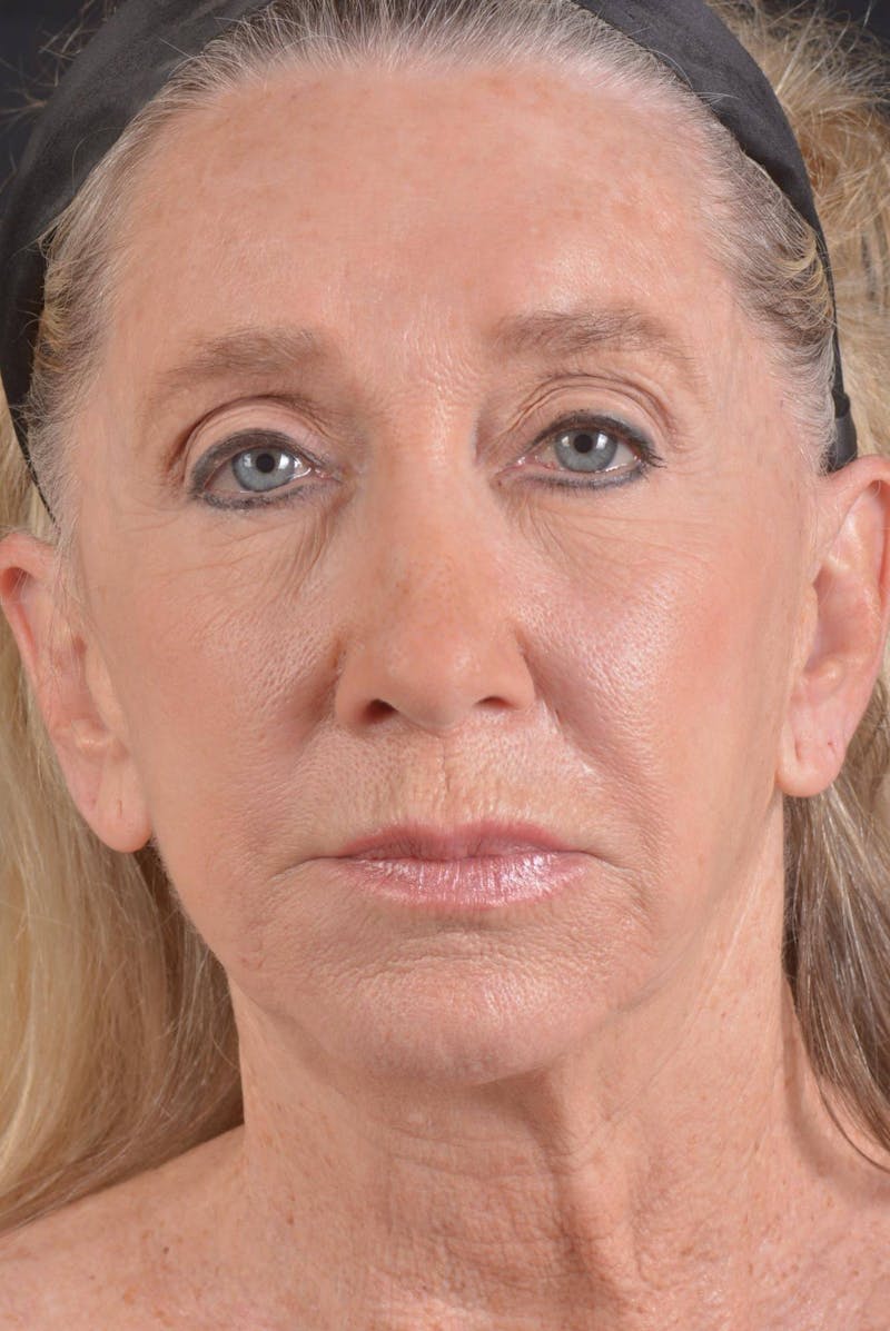 Facelift Before & After Gallery - Patient 262486 - Image 1