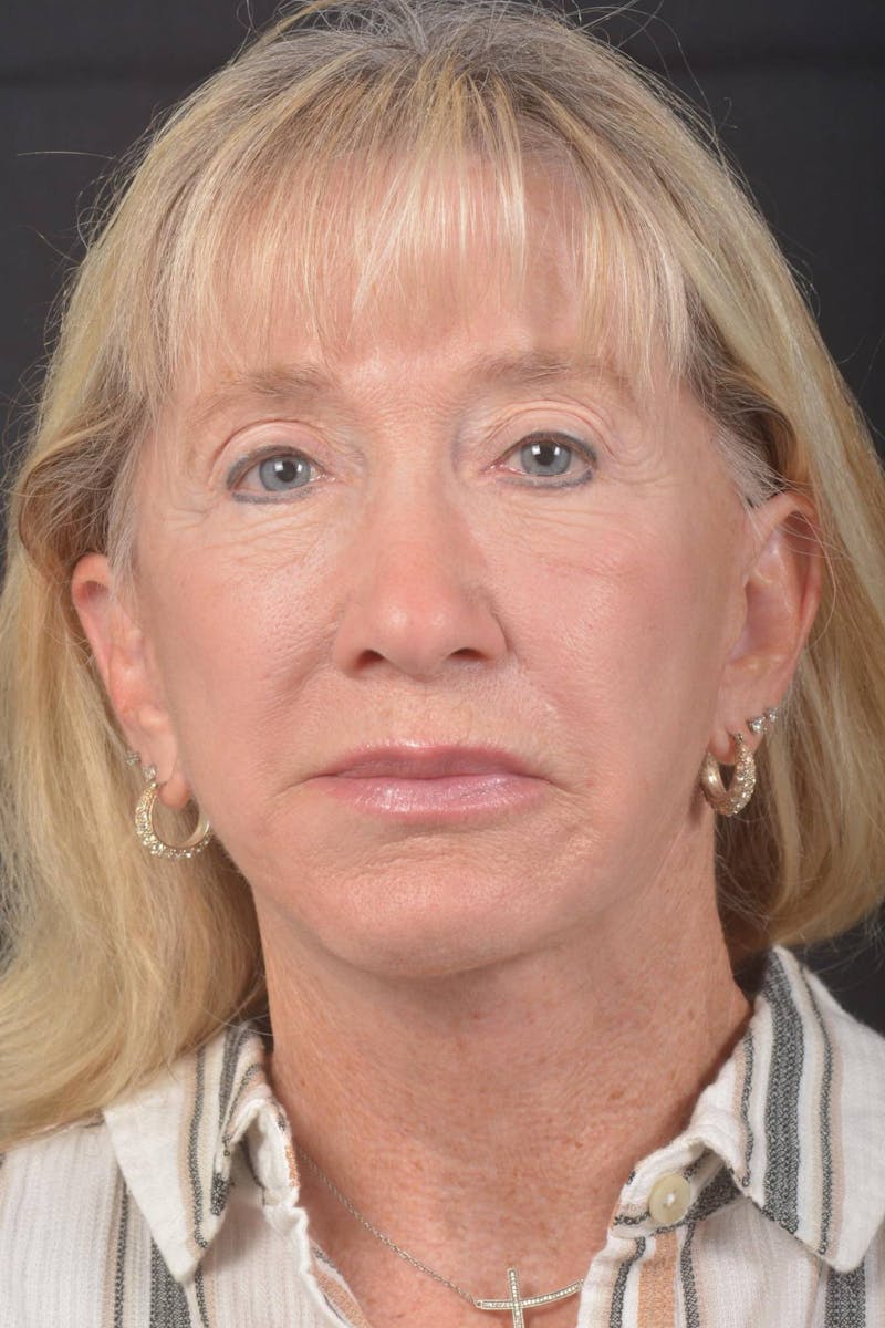 Facelift Before & After Gallery - Patient 262486 - Image 2