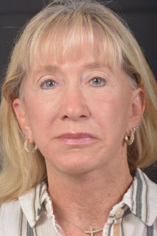 Facelift Before & After Gallery - Patient 262486 - Image 2