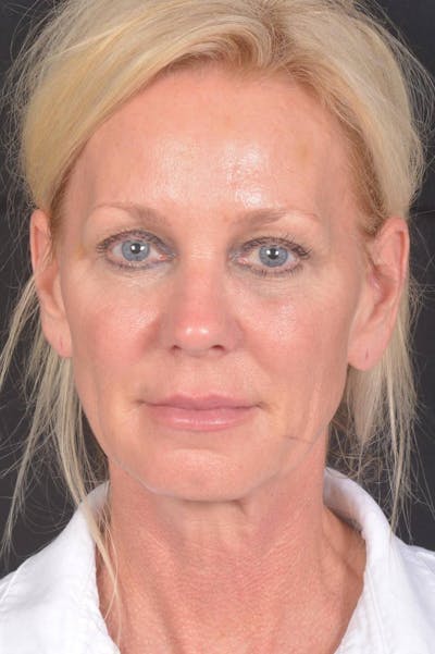 Facelift Before & After Gallery - Patient 246662 - Image 1